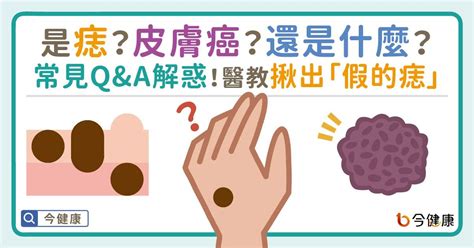 頭上有肉痣|是痣or皮膚癌？醫「1張圖秒對照」 長這2部位最危險